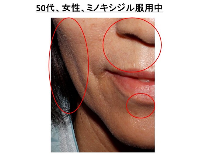 円形脱毛症　病院
